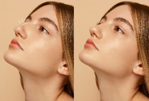 Rhinoplasty