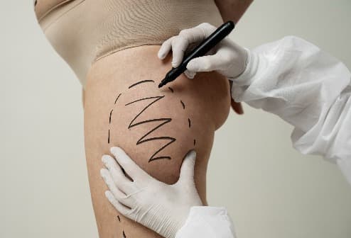 Liposuction