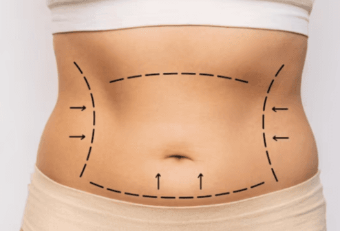 Abdominoplasty (Tummy Tuck)