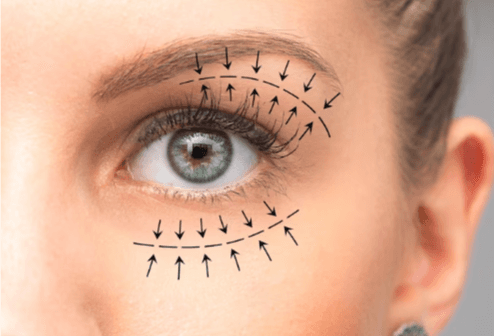 Eyelid Surgery