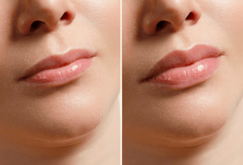 Lip Augmentation