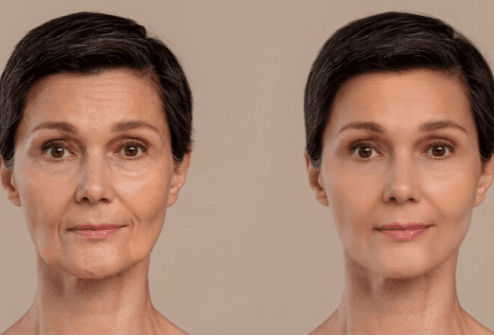 Facelift